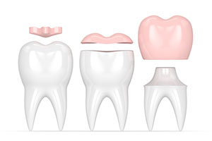 Dental Crowns