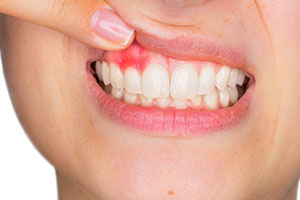 Gum Disease Treatment
